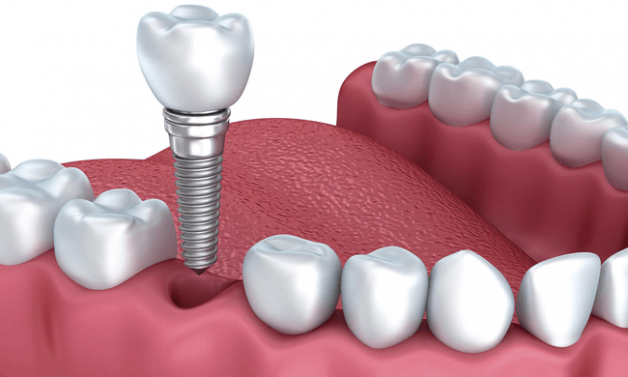 Lưu ý sau khi cấy ghép implant để nhanh hồi phục | TCI Hospital